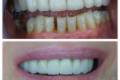 round bridge from metal-ceramic (replacement of the old denture)